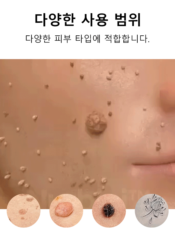 레이저 무통 사마귀 제거 펜