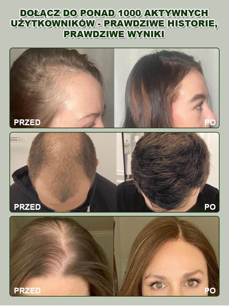 【Cudowne narzędzie na gęste włosy】Głębokie pobudzenie mieszków włosowych