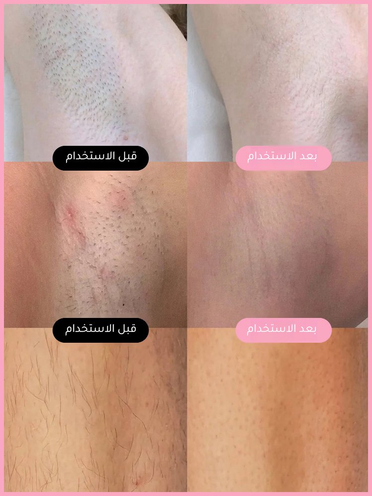 جهاز إزالة شعر جسم متعدد الوظائف 2 في 1 لإزالة شعر منطقة البيكيني بدون الألم 