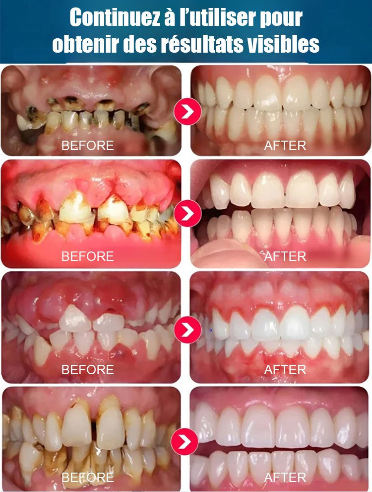 Sérum protecteur dentaire spécialisé pour la régénération de l'émail dentaire