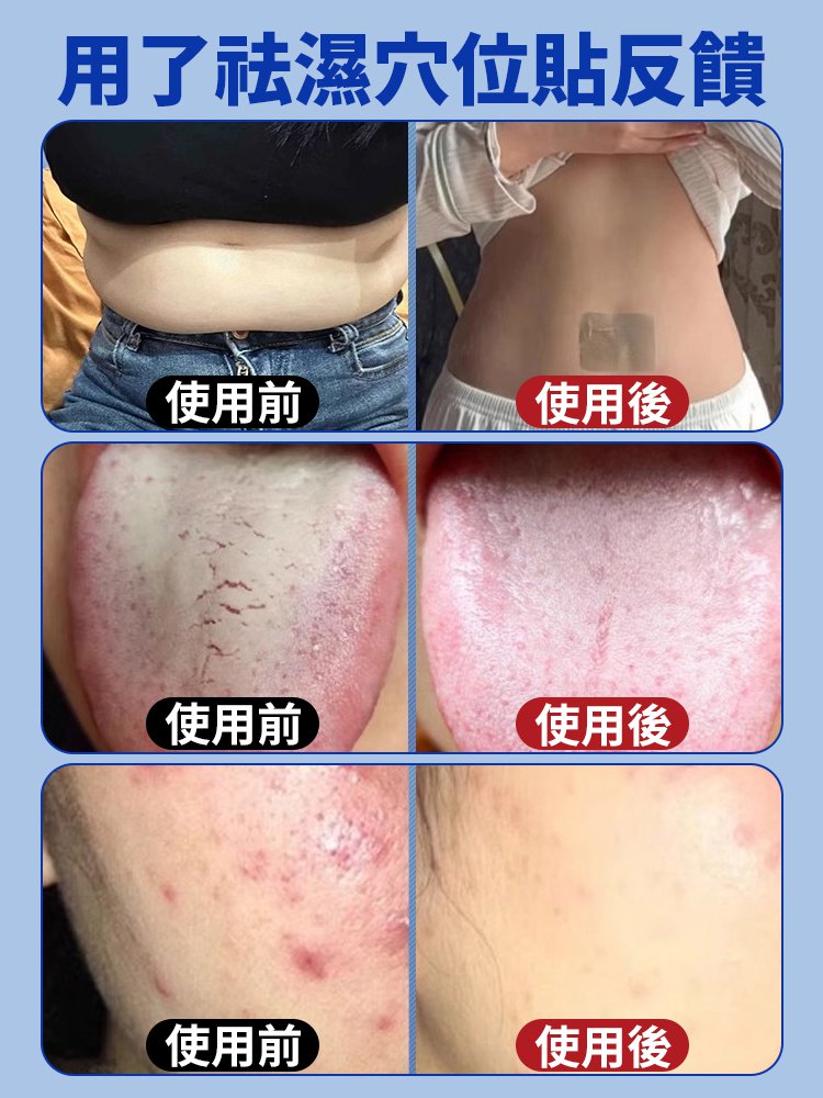 【速效祛濕】草本排毒穴位祛濕貼