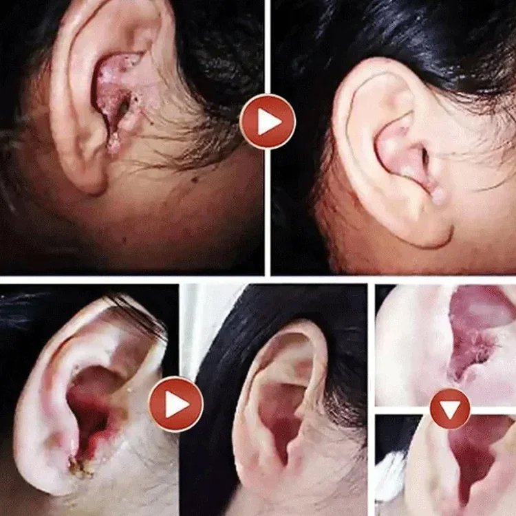 【Enfocado en la salud auditiva】Limpiador de cerumen