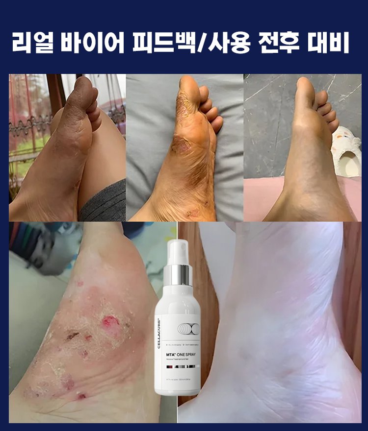 발 진균 관리 스프레이