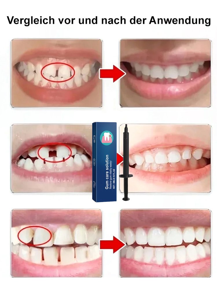 Oralhoe Zahnfleischschutzmittel