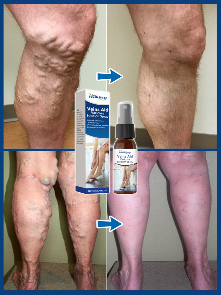 Spray do pielęgnacji żył nóg