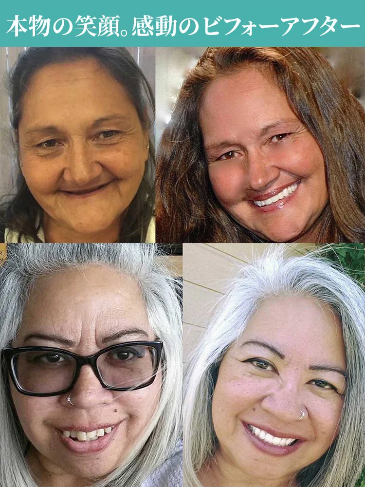 【ドイツVDDI社開発】審美ホワイトニング義歯