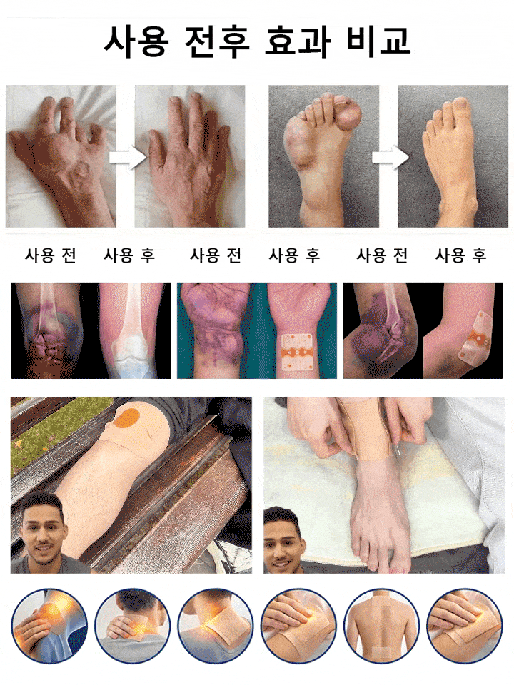 【수술 없이】투골 케어 패치
