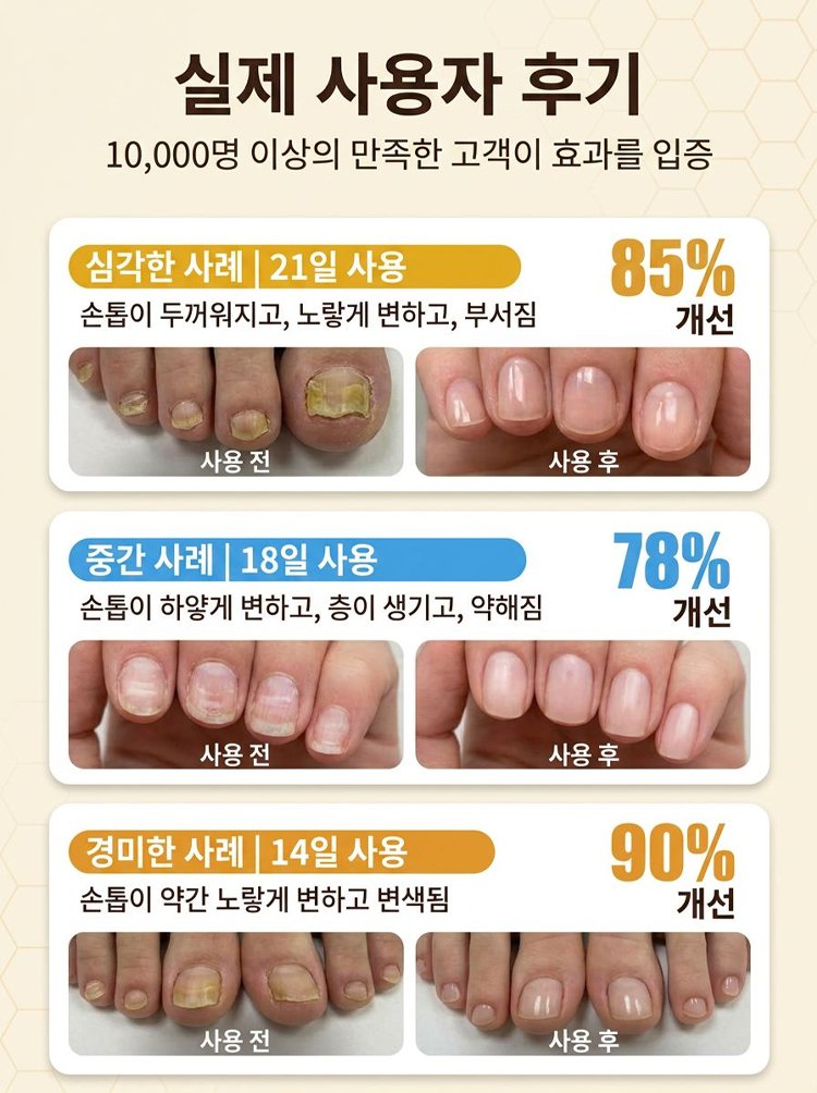 [7일 기적] 갈아낼 필요 없는 문제성 발톱 뿌리 파괴 벌독 앰플