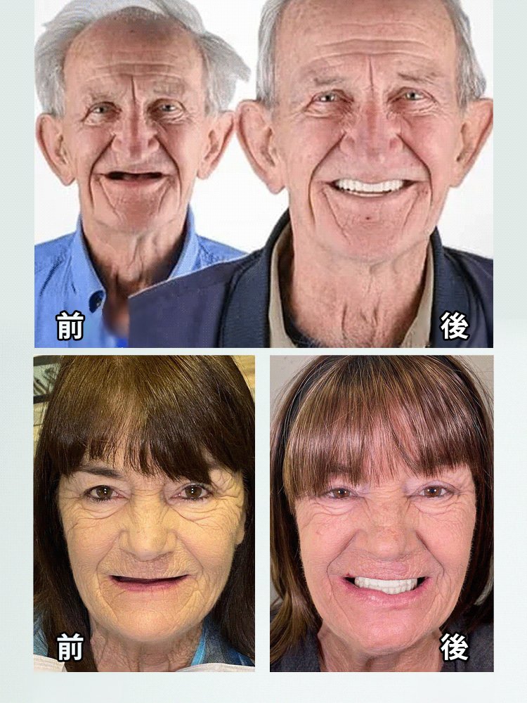 カスタムフィットマウスピース