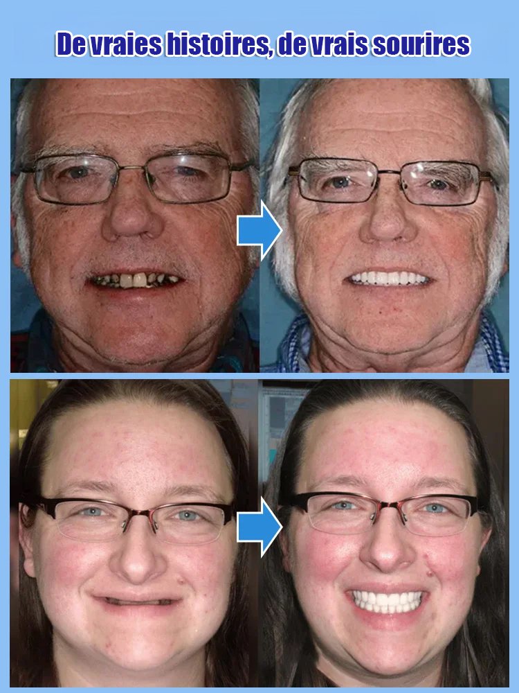 ⭐Transformez votre sourire en 30 secondes : La Prothèse en Silicone Souple n°1 en France