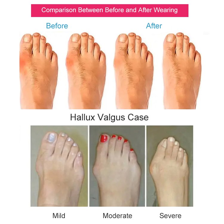 Hallux Valgus Correction Slippers
