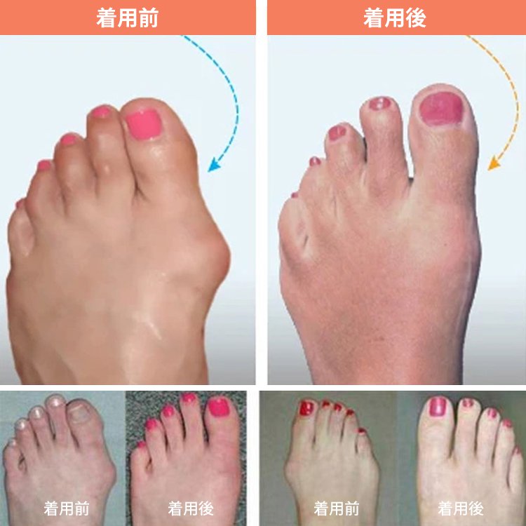 【外反母趾対策サンダル】柔らかい、ラウンドトゥ、牛革、 ウェッジソール、履き心地が快適