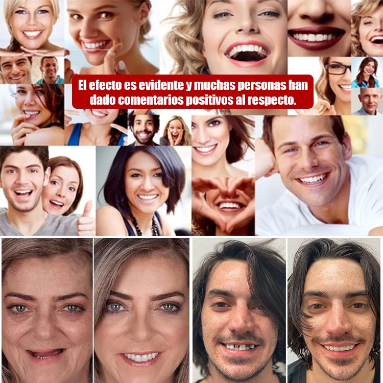 Conjunto de carillas cosméticas para dientes.