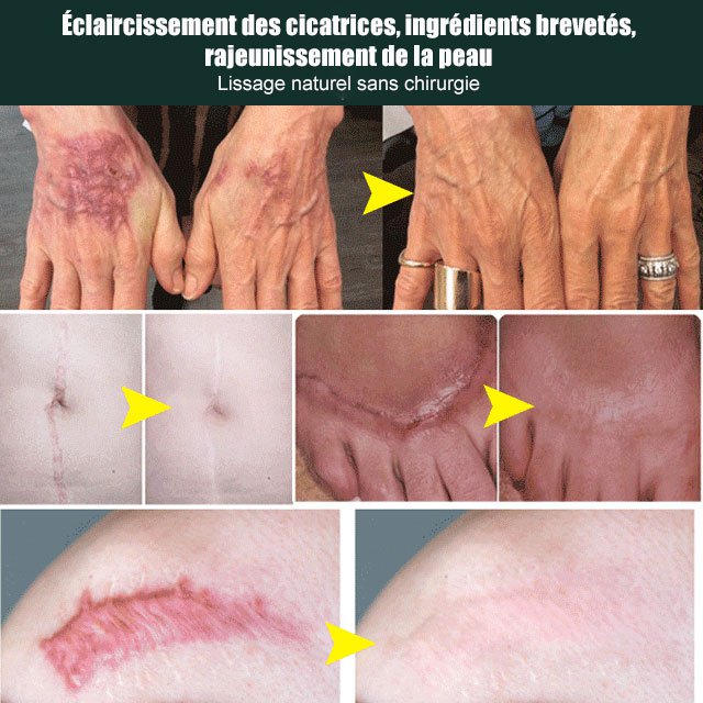 ÉLIMINE LES CICATRICES