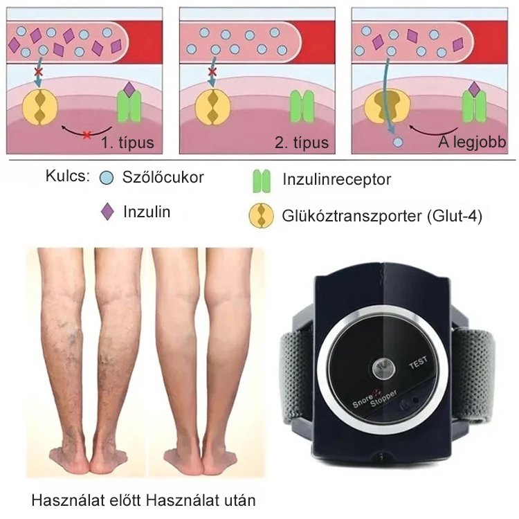 Csuklóra szerelt elektronikus infravörös glükózcsökkentő és horkolásmegállító készülék