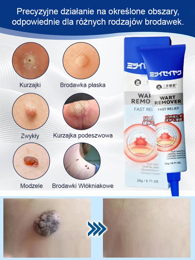 【Trzy sekundy na usunięcie brodawek】Japońska maść Mitsui Pharmaceutical na brodawki