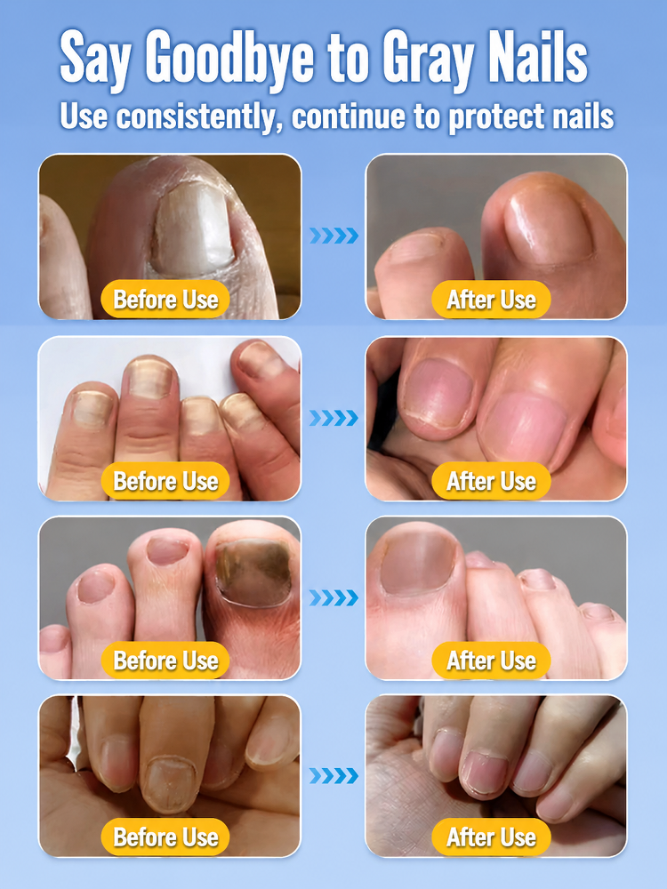 SL-[Painless and Gentle Nail Replacement] Herbal Nail Remover Oil