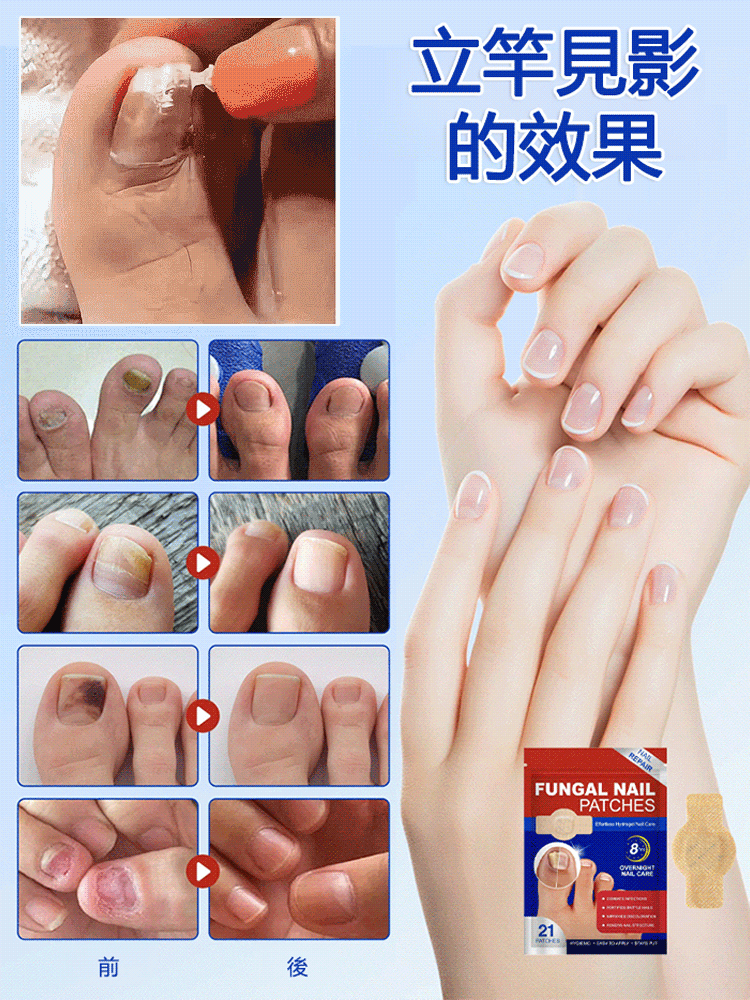 指甲修護矯正抑菌貼