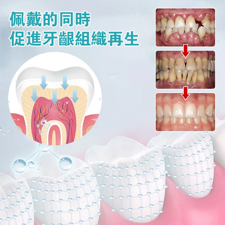 可調節卡扣式假牙