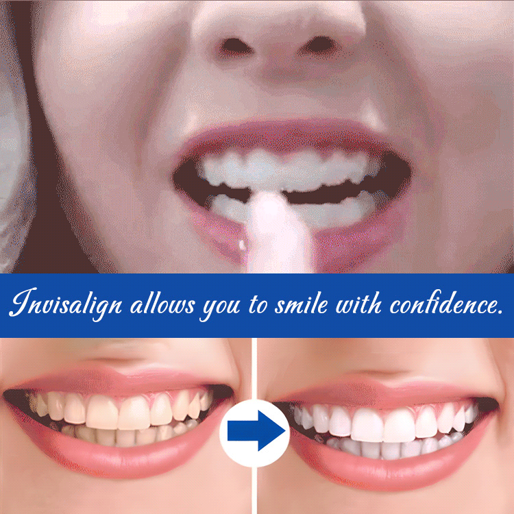 SimulatedSilicone Braces