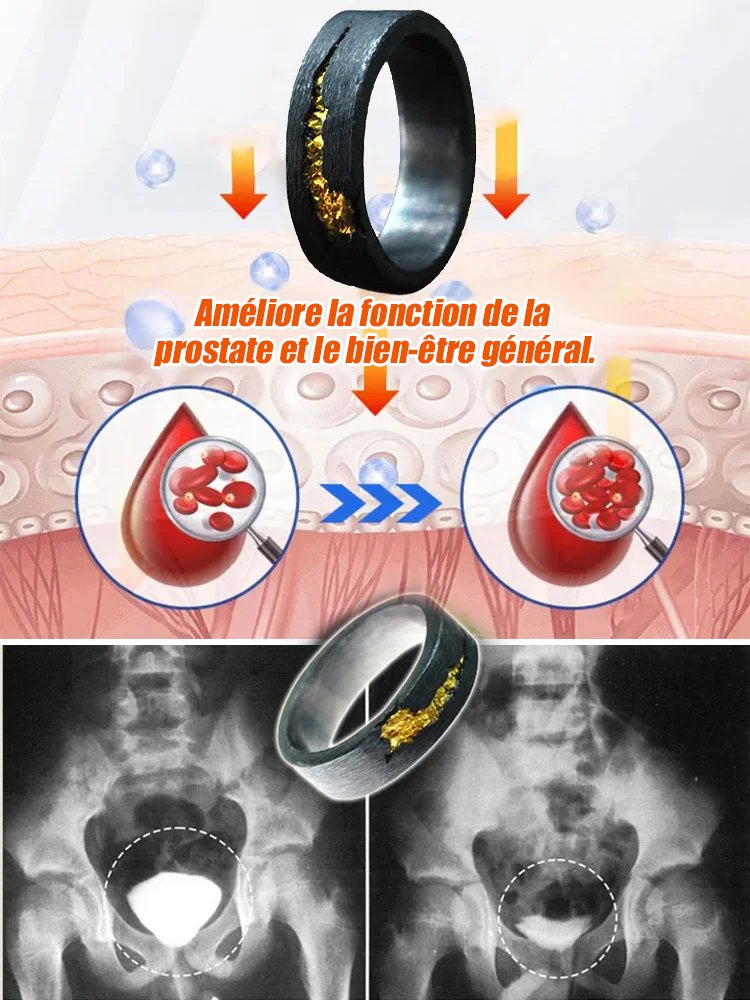 Anneau de traitement de la prostate à motif gaufré
