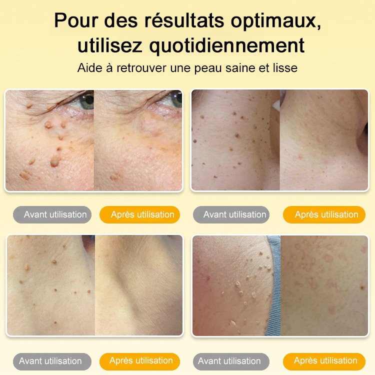 BOOMOON Spray de soin pour verrues au venin d'abeille