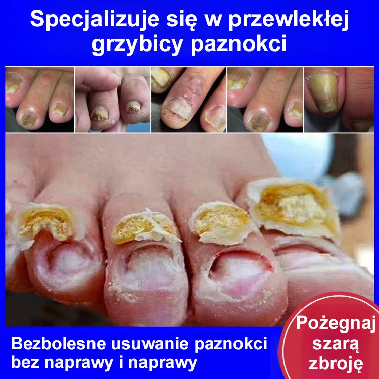 [Bezbolesne i bez nawrotów] Maść na grzybicę paznokci