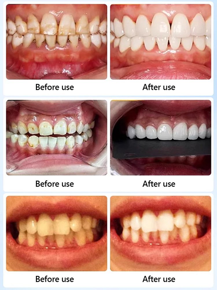 【At-Home Dental Whitening】Instant Whitening Strips