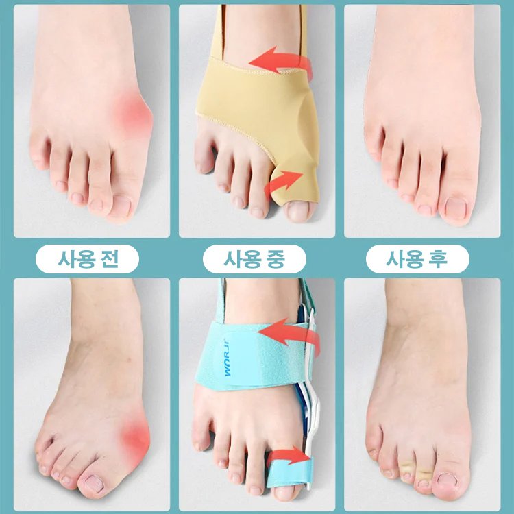 무지외반 교정기