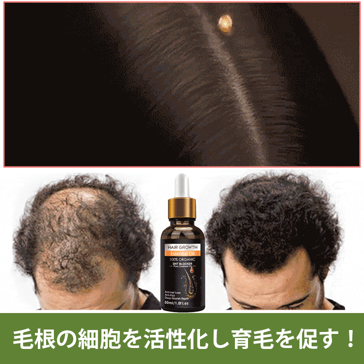 発毛剤